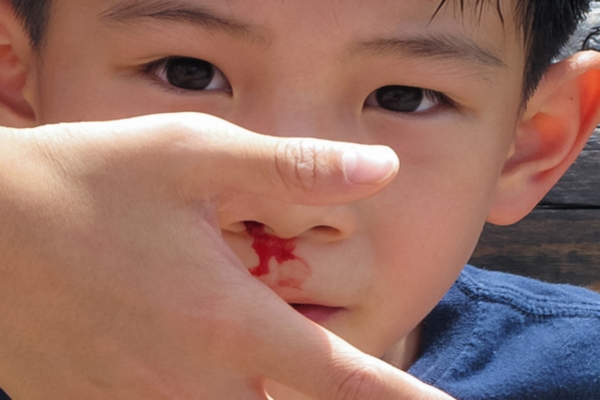Bài thuốc thảo dược quý đẩy lui chảy máu cam cho trẻ em, người lớn an toàn và hiệu quả